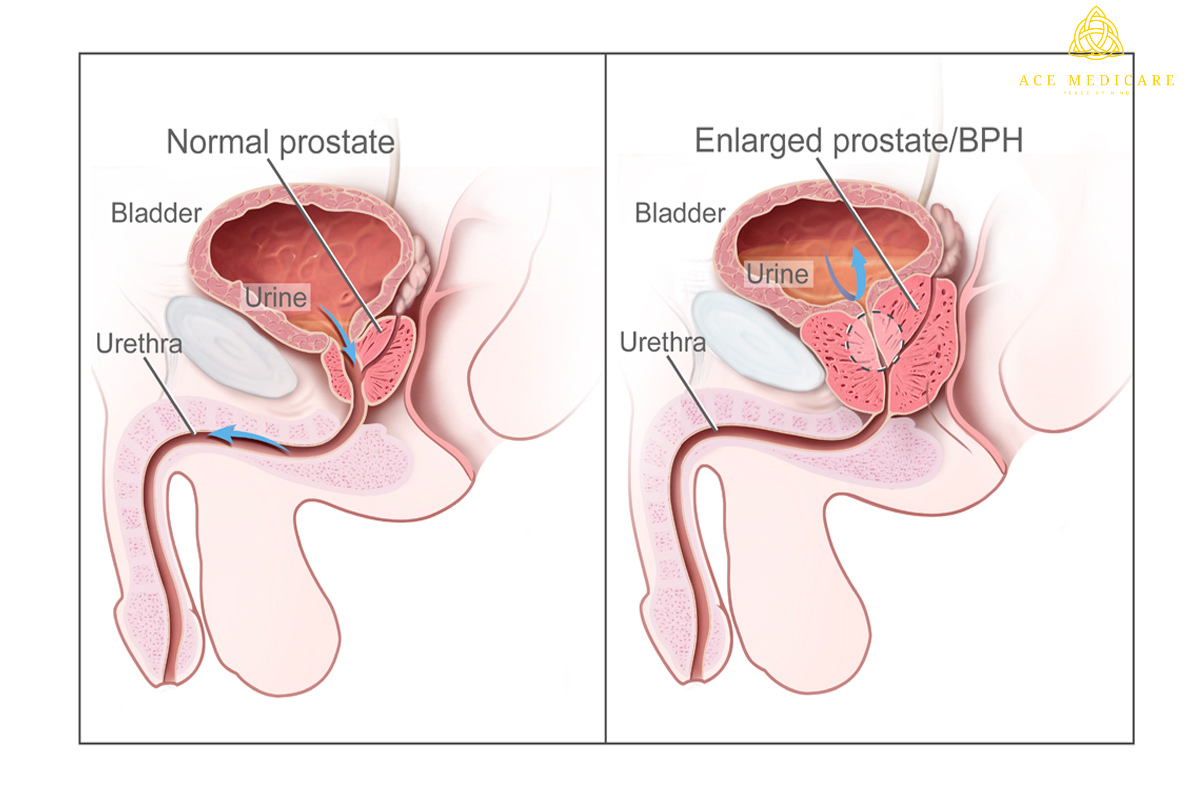 Enlarged Prostate and Exercise: Physical Activity for Prostate Health